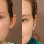 Conjunto AuricFix – Clip Corrector de Orejas