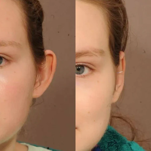 Conjunto AuricFix – Clip Corrector de Orejas