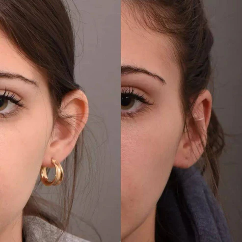 Conjunto AuricFix – Clip Corrector de Orejas