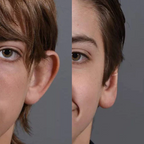 Conjunto AuricFix – Clip Corrector de Orejas