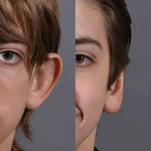 Conjunto AuricFix – Clip Corrector de Orejas