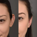 Conjunto AuricFix – Clip Corrector de Orejas