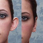 Conjunto AuricFix – Clip Corrector de Orejas