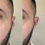 Conjunto AuricFix – Clip Corrector de Orejas