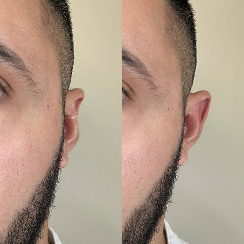 Conjunto AuricFix – Clip Corrector de Orejas